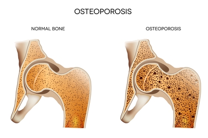 osteo1.jpg